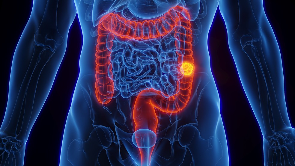 SUS adota novo exame para detectar câncer de intestino antes dos sintomas – Imprensa Bahia